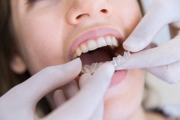 Orthodontic Treatment in Noida